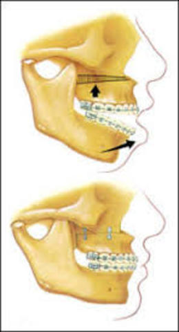 Jaw Surgery