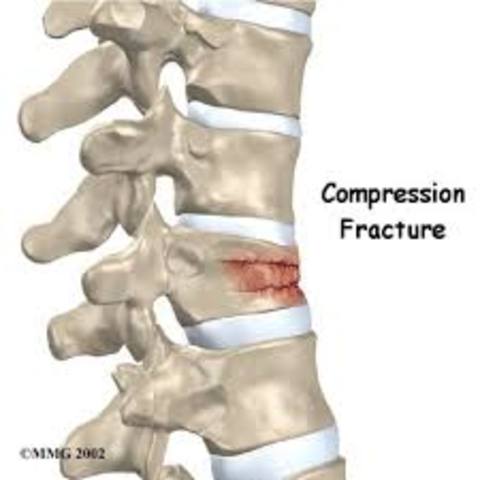 fractured back