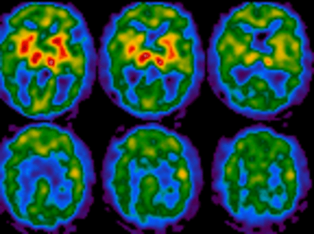 Parkinsons gene discovered