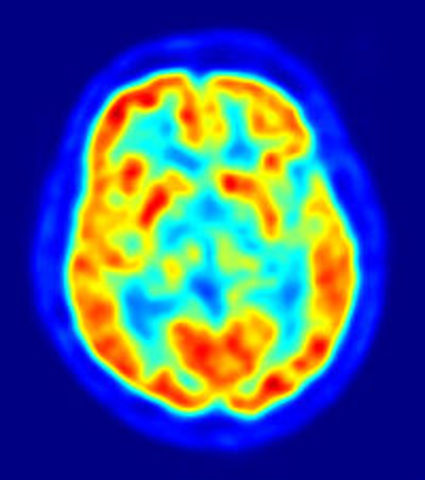 The first functioning PET scan is created