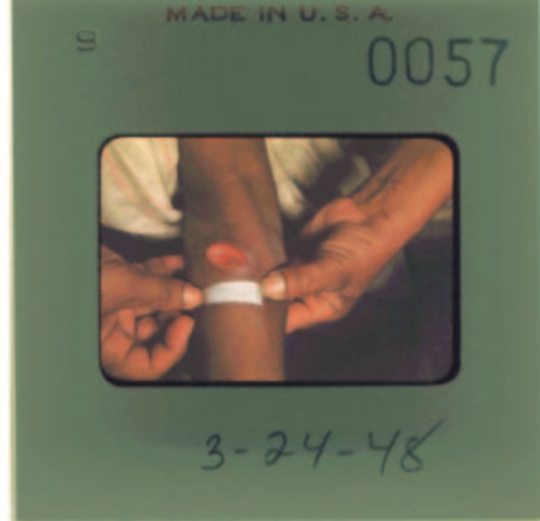 USPHS ends the Guatemala syphilis study