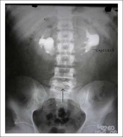 1988 NC Spina Bifida