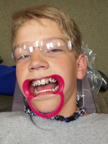 Got braces