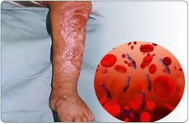 Transmite Septicemia