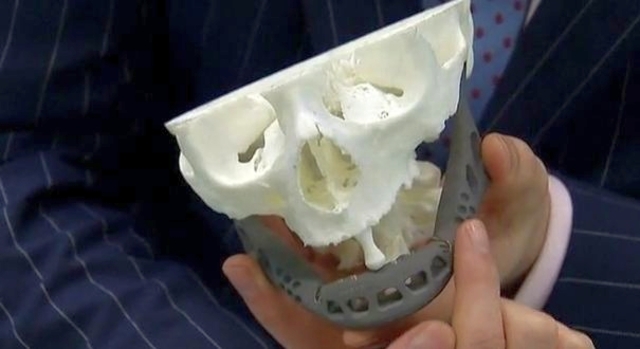 The first prosthetic jaw is printed and implanted