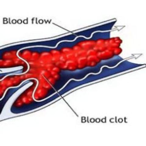 Discovery to prevention for blood clotting