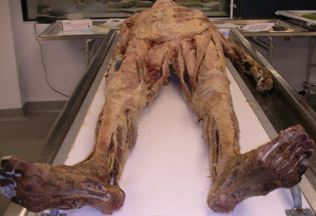 Cadavar Transfusioin