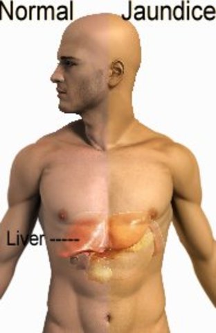 Jaundice