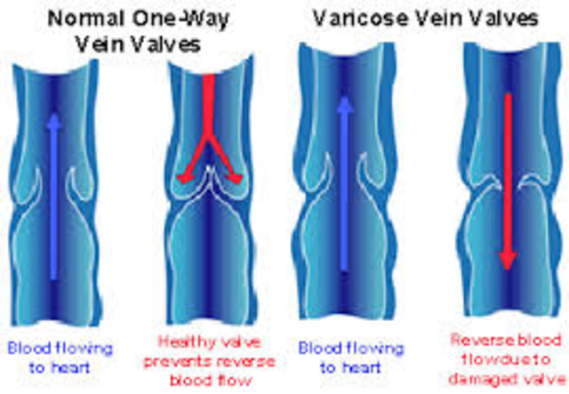 Vein Valves