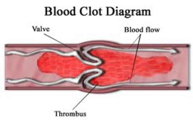 clots