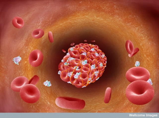 Platelets make up clots