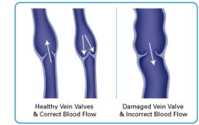 In the valves in veins