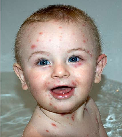 First Vaccine for Chickenpox