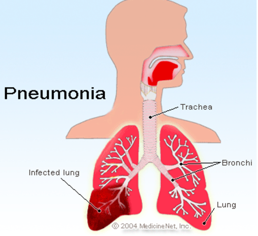 First Vaccine for Pneumonia