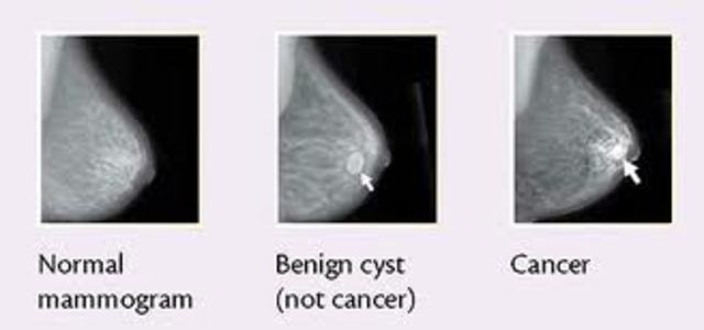 Breast Cancer
