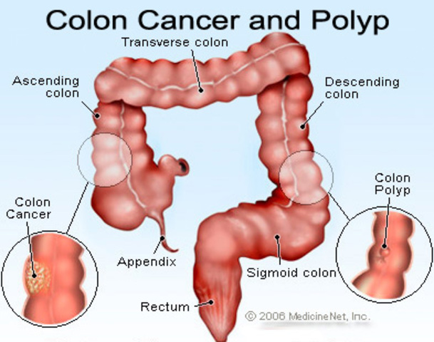 Colorectal Cancer and Polyps