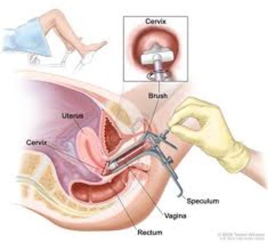 Cervical Cancer