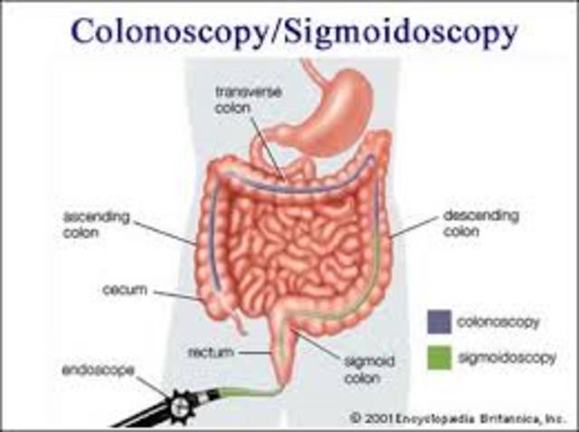 Colorectal Cancer
