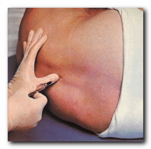 The use of spinal anesthesia (epidural anesthesia) had begun, but was not inducted into clinical practice until some time later.