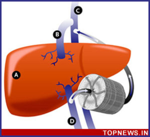 Artificial Liver