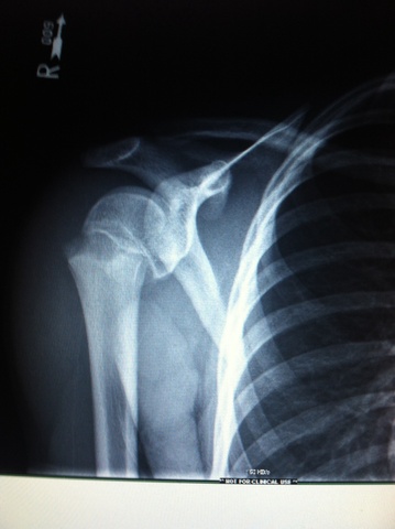 My first serious injury