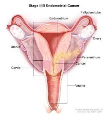 Endometrial Cancer