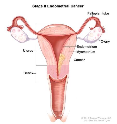 Endometrial Cancer