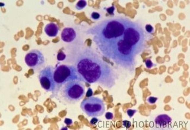 The Discovery of a Malignant tumor