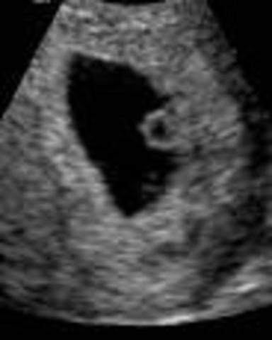 found out we miscarried