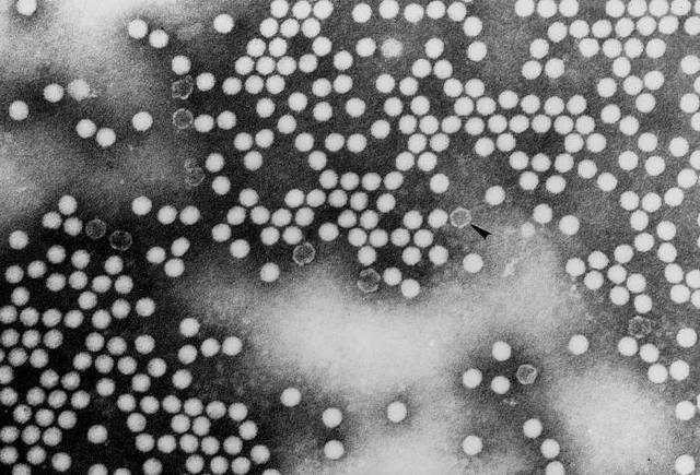 Last Poliovirus Case in the U.S.