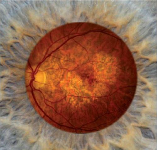 Possible Treatment for Color Blindness