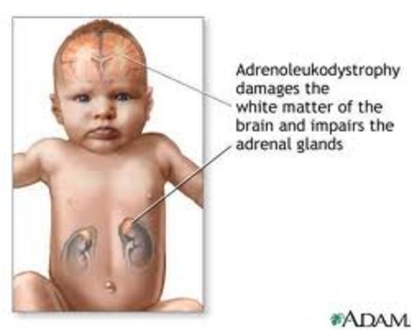 Treatment of ALD