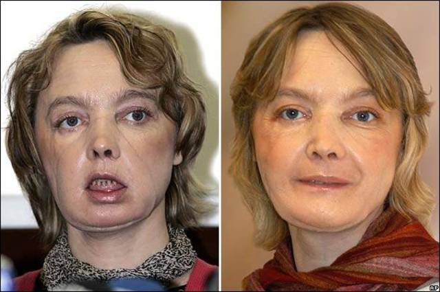 Jean-Micheal Dubernard performs the first partial face transplant