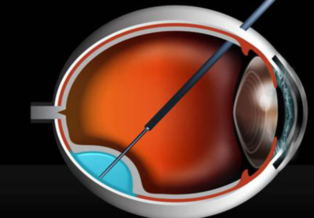 Work Towards Treatments for Blindness