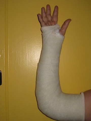Broke right arm. (Biosocial)