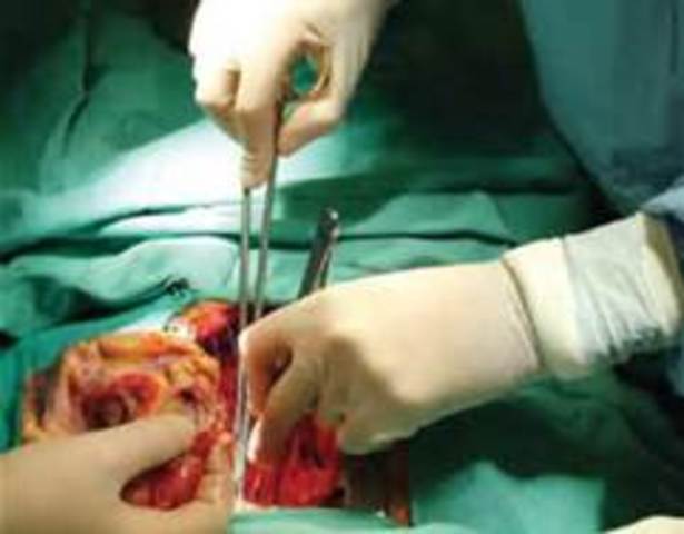 First Heart Transplant