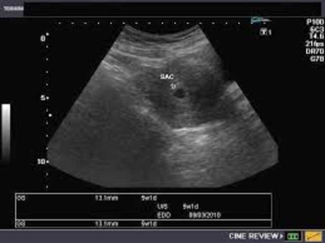 I Find Out I'm Pregnant!