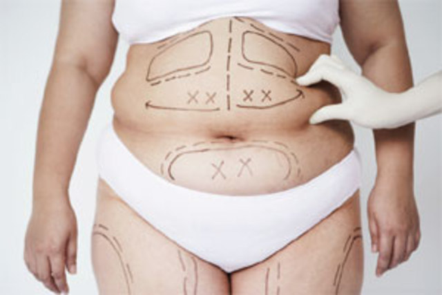 Liposuction