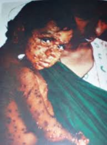 The Smallpox epidemic