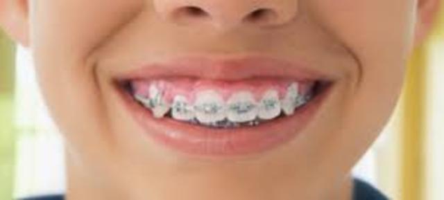 Braces