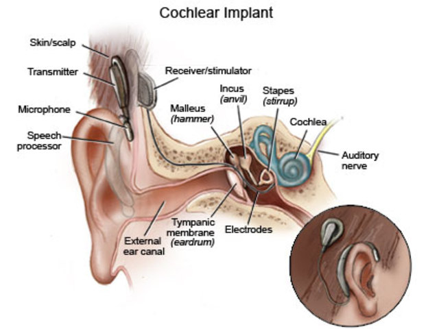 1985-Cochlear Implants