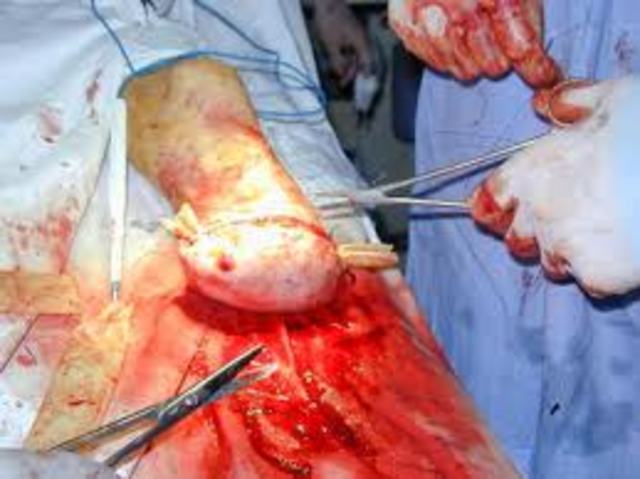 kemmirch gets his leg amputaed