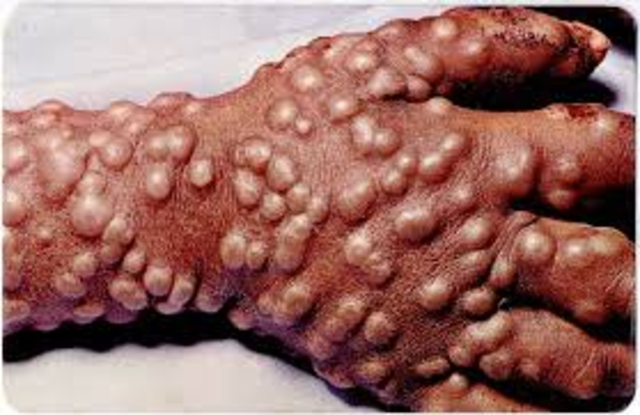 Smallpox epidemic breaks out