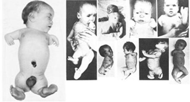 Thalidomide Children