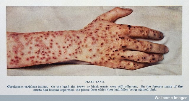 Small Pox's gets Big