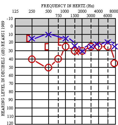 I started loosing my hearing.