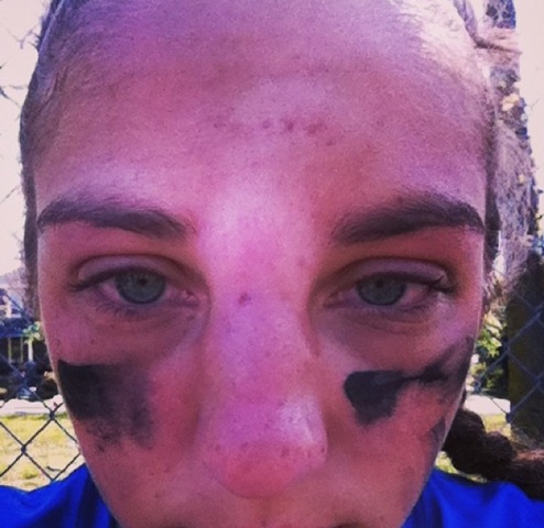 My first broken bone