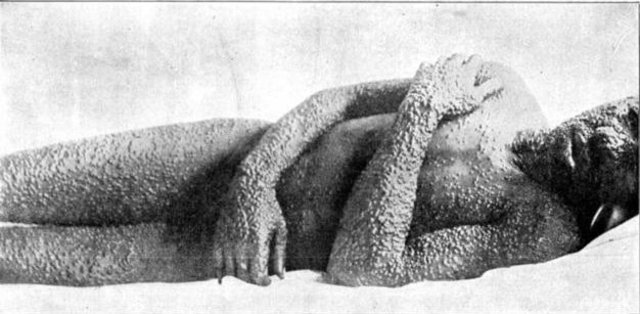 Industrial scale production of Smallpox begins in Russia