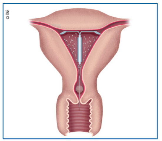 Dispositivo Intrauterino