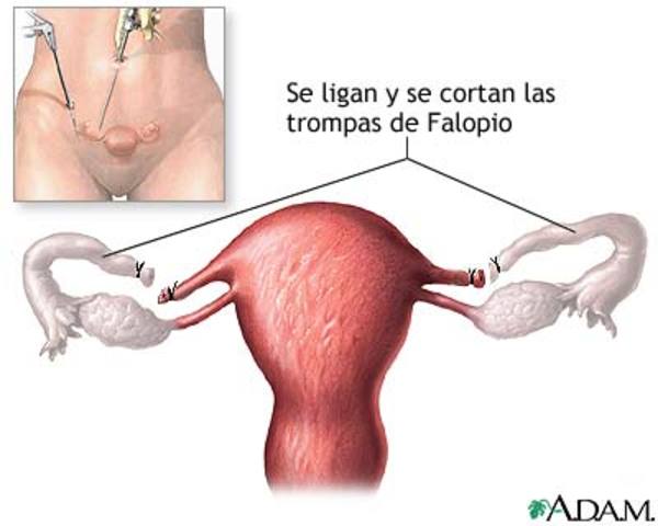 Esterilización